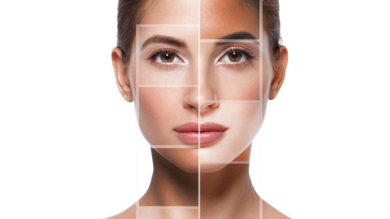 Laser Skin Resurfacing